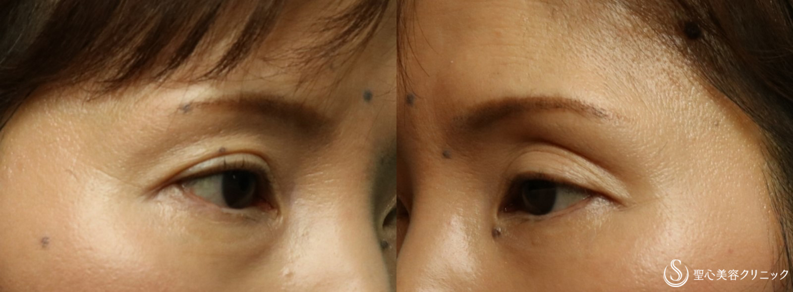 【40代女性・目の上のくぼみ】プレミアムPRP皮膚再生療法（2か月後） Before 