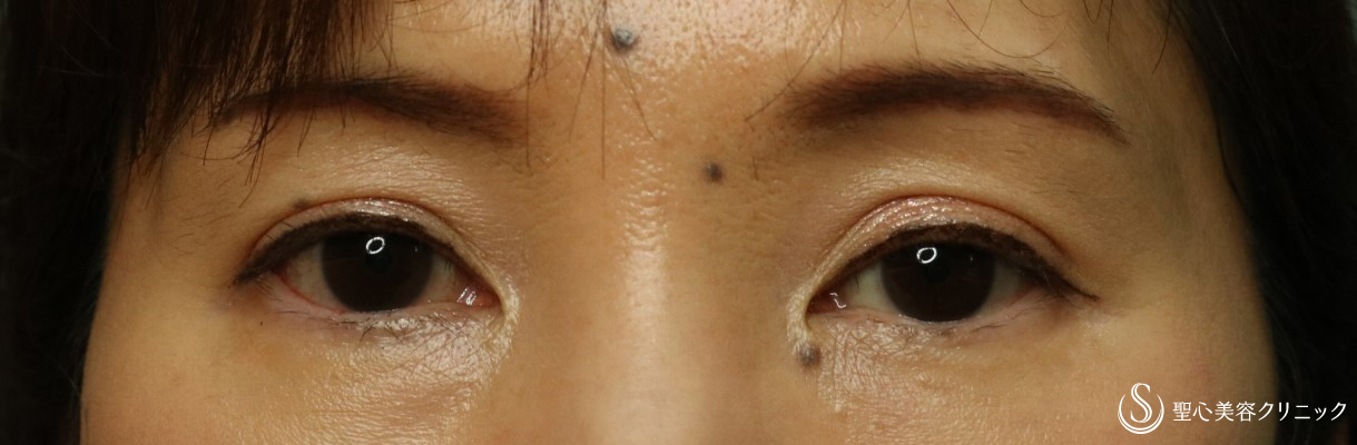 【40代女性・目の上のくぼみ】プレミアムPRP皮膚再生療法（2か月後） After 