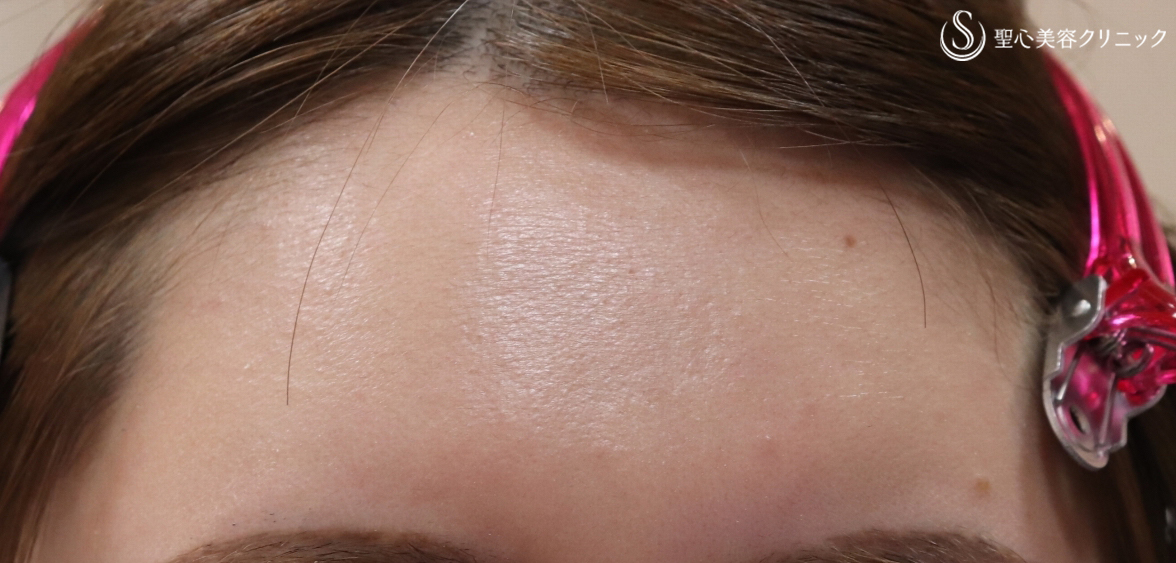 【30代女性・額をツヤっと綺麗に】プレミアムPRP皮膚再生療法(5ヶ月後) After 