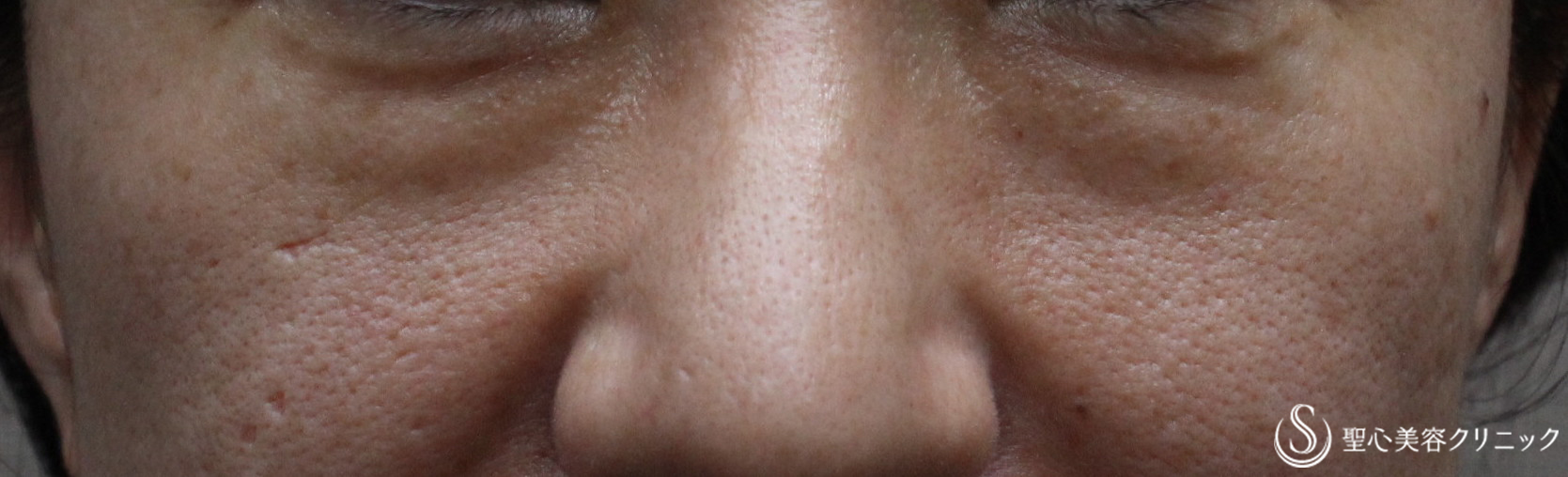 【40代女性・切らないクマ治療】プレミアムPRP皮膚再生療法（３ヶ月後） Before 