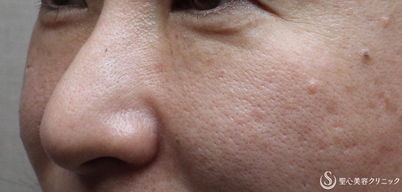 【40代女性・切らないクマ治療】プレミアムPRP皮膚再生療法（３ヶ月後） After 