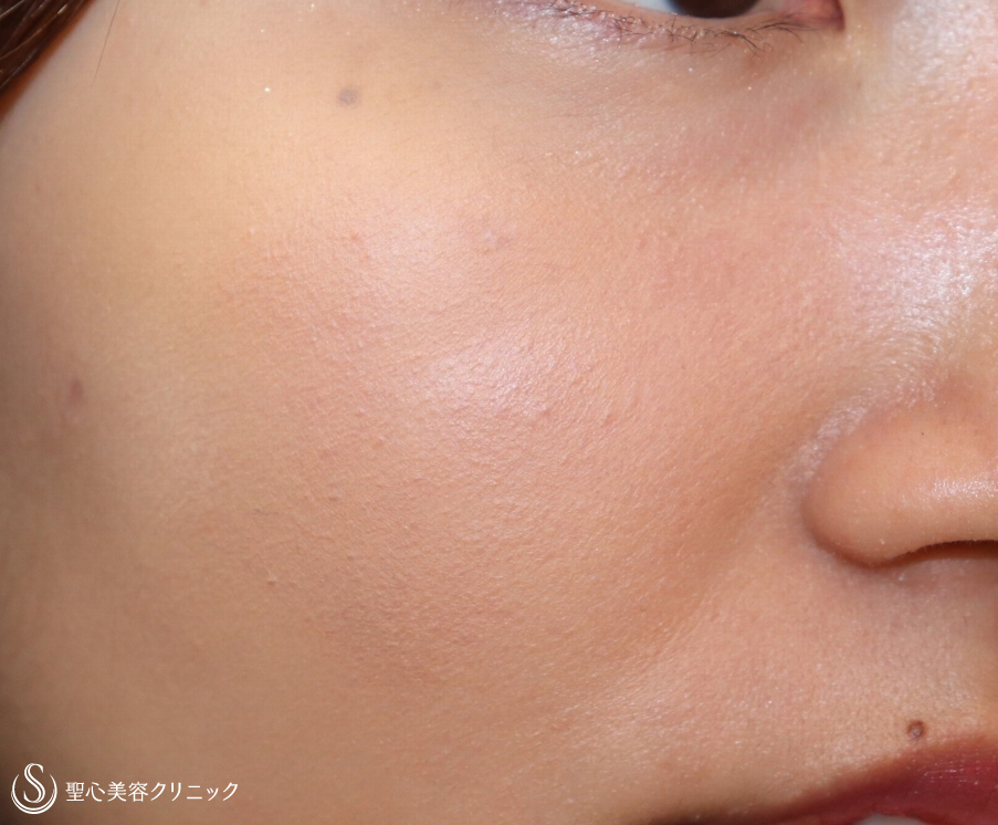 【20代女性・顔のホクロを綺麗に！】電気凝固法（2ヶ月半後） After 