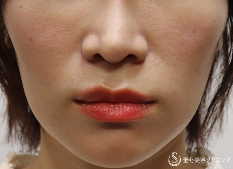 【30代女性・頬のコケを解決】プレミアムPRP皮膚再生療法（６ヶ月後） Before 