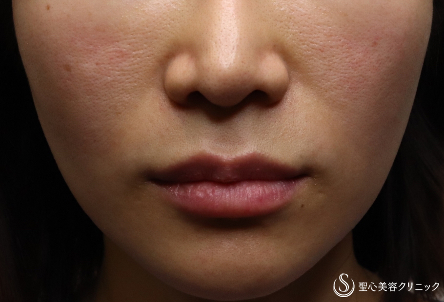 【30代女性・頬のコケを解決】プレミアムPRP皮膚再生療法（６ヶ月後） After 