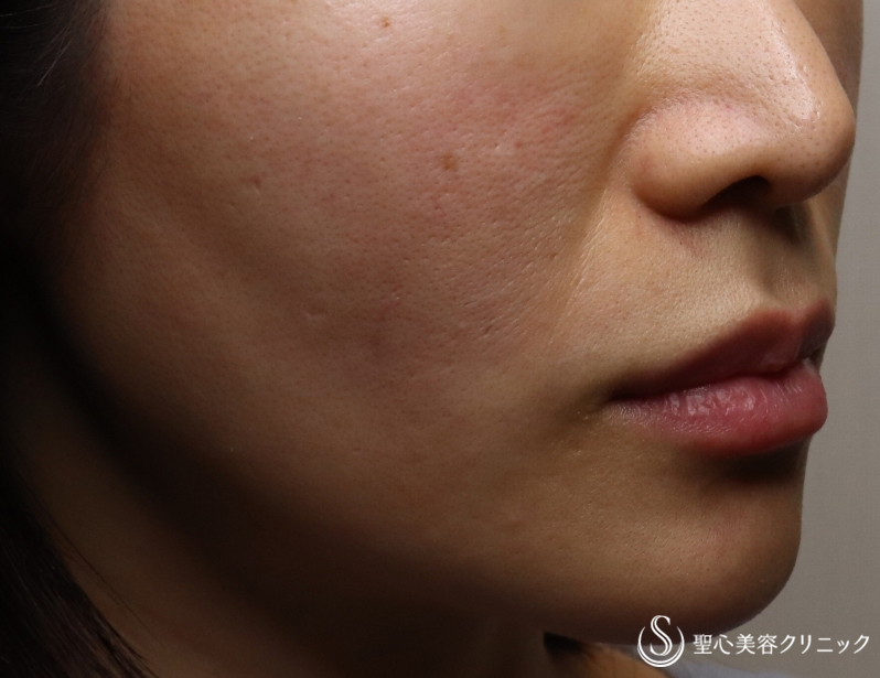 【30代女性・頬のコケを解決】プレミアムPRP皮膚再生療法（６ヶ月後） After 
