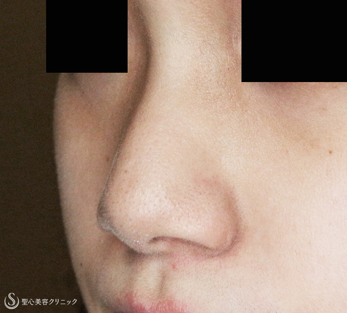 【20代女性・小鼻をスマートに】小鼻縮小術+α法（2年2ヶ月後） Before 