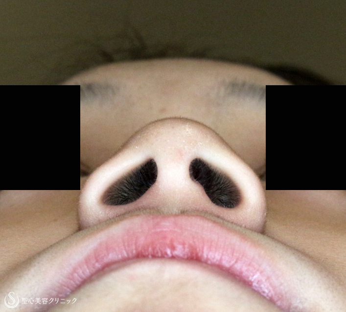 【20代女性・小鼻をスマートに】小鼻縮小術+α法（2年2ヶ月後） Before 