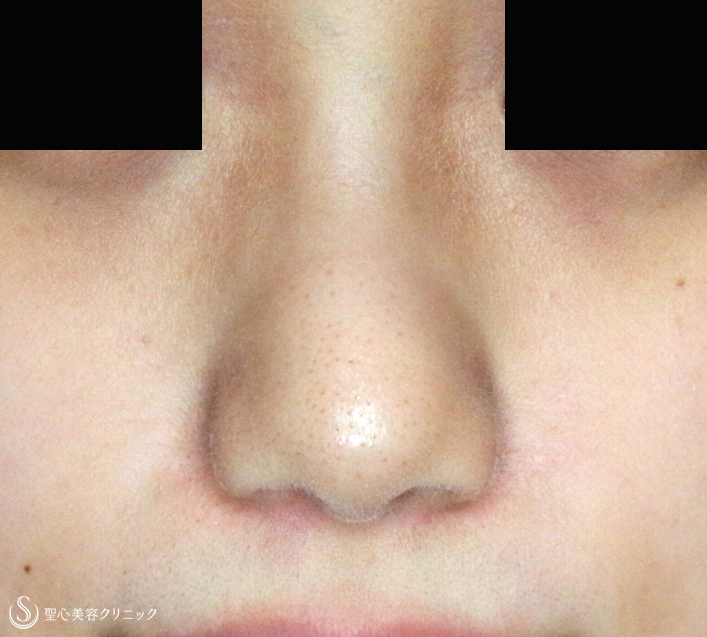 【20代女性・小鼻をスマートに】小鼻縮小術+α法（2年2ヶ月後） After 
