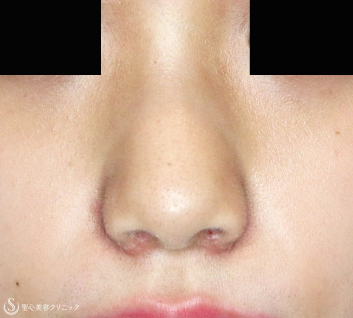 【20代女性・小鼻をスマートに】小鼻縮小術+α法（2年2ヶ月後） After 