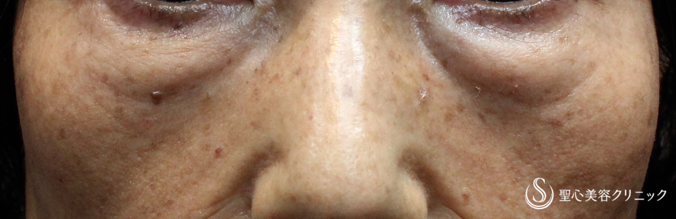 【60代女性・眼窩脂肪の膨らみを手術せず解消】プレミアムPRP皮膚再生療法（４ヶ月後） Before 