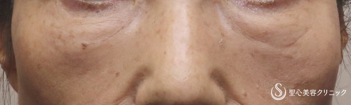 【60代女性・眼窩脂肪の膨らみを手術せず解消】プレミアムPRP皮膚再生療法（４ヶ月後） After 