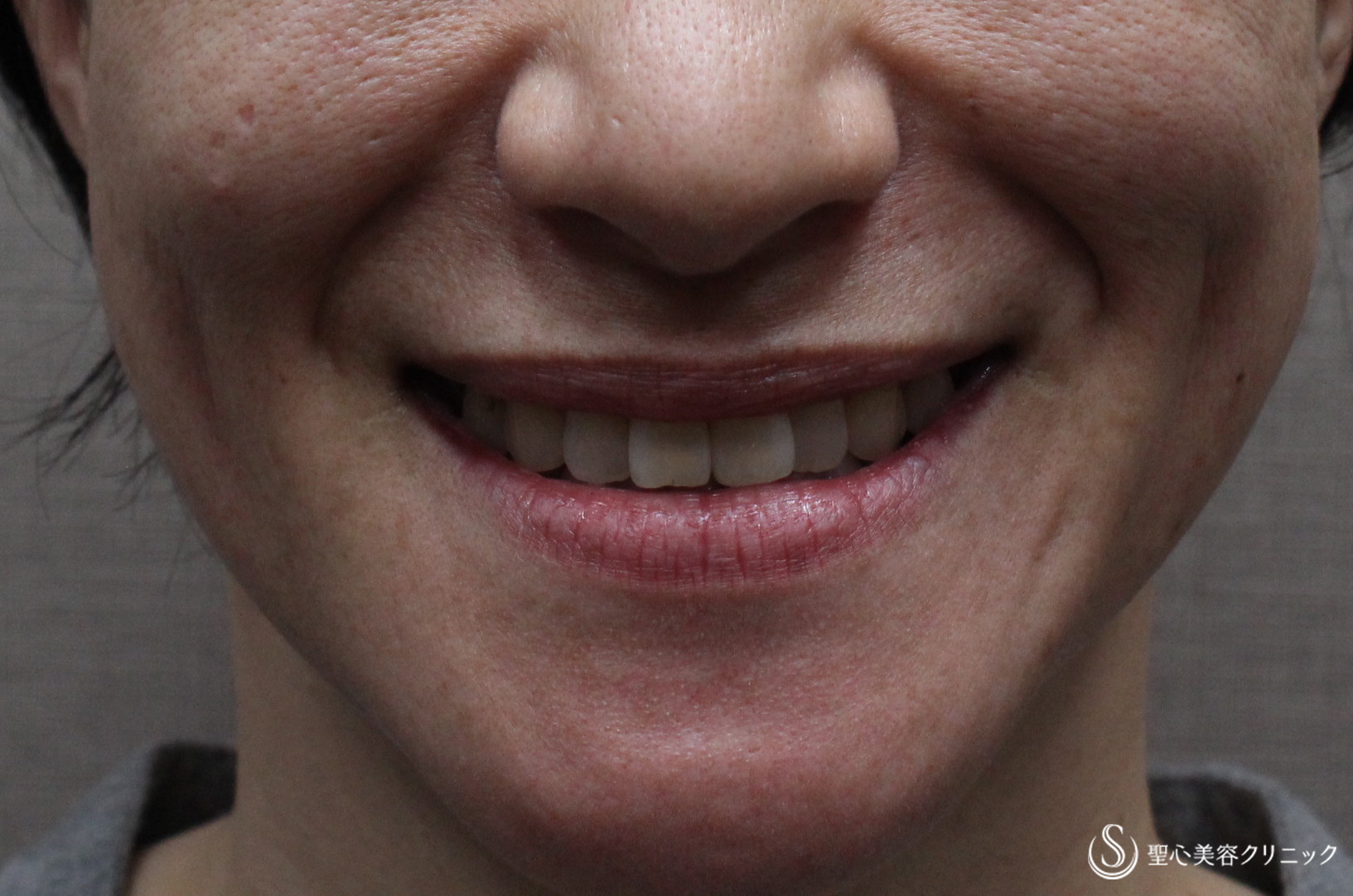 【40代女性・笑った時のシワを解消】プレミアムPRP皮膚再生療法（３ヶ月後） Before 