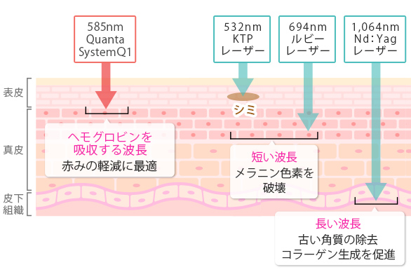 585nm Quanta SystemQ1:ヘモグロビンを吸収する波長 赤みの軽減に最適、532nm KTPレーザー/694ルビーレーザー:短い波長 メラニン色素を破壊、1064nm Nd:Yagレーザー:長い波長 古い角質の除去・コラーゲン生成を促進