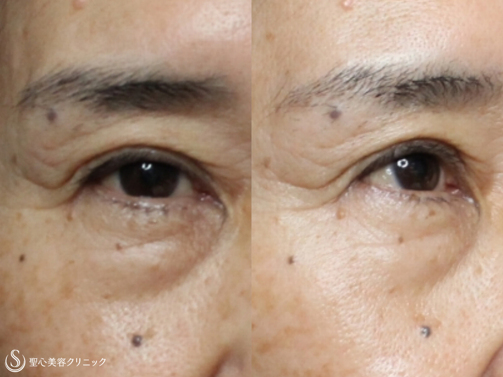 【60代女性・目元を若々しく！】眉下切開法+プレミアムPRP皮膚再生療法（1か月後） Before 