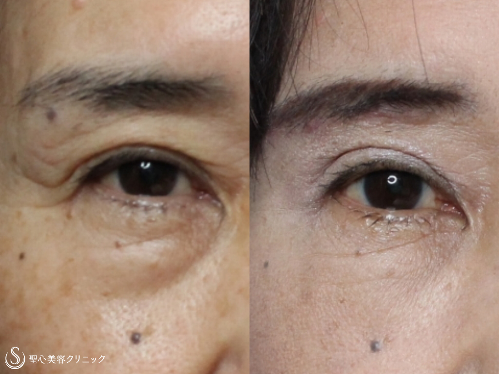 【60代女性・目元を若々しく！】眉下切開法+プレミアムPRP皮膚再生療法（1か月後） After 