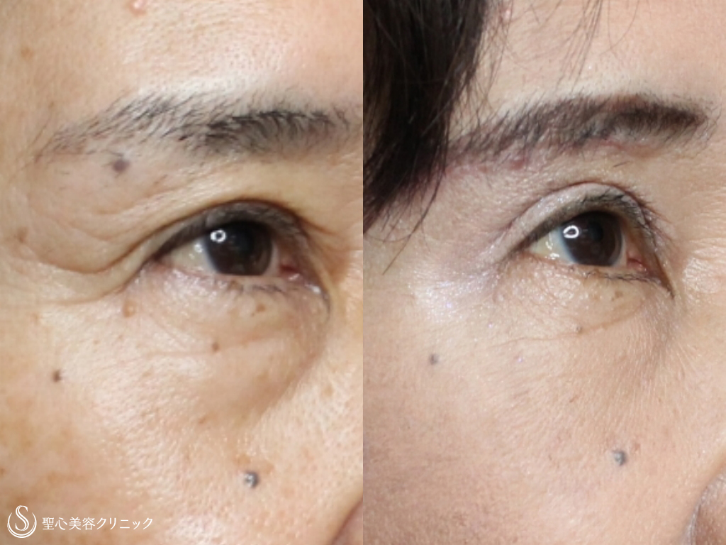 【60代女性・目元を若々しく！】眉下切開法+プレミアムPRP皮膚再生療法（1か月後） After 