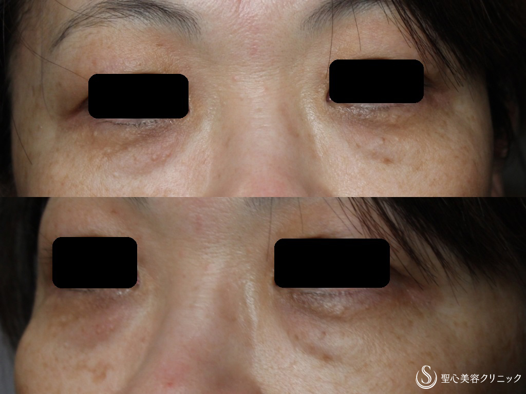 【50代女性・皮膚を切らない目の下の若返り】経結膜下脱脂法+プレミアムPRP皮膚再生療法（1か月後） Before 
