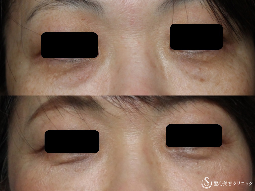 【50代女性・皮膚を切らない目の下の若返り】経結膜下脱脂法+プレミアムPRP皮膚再生療法（1か月後） After 