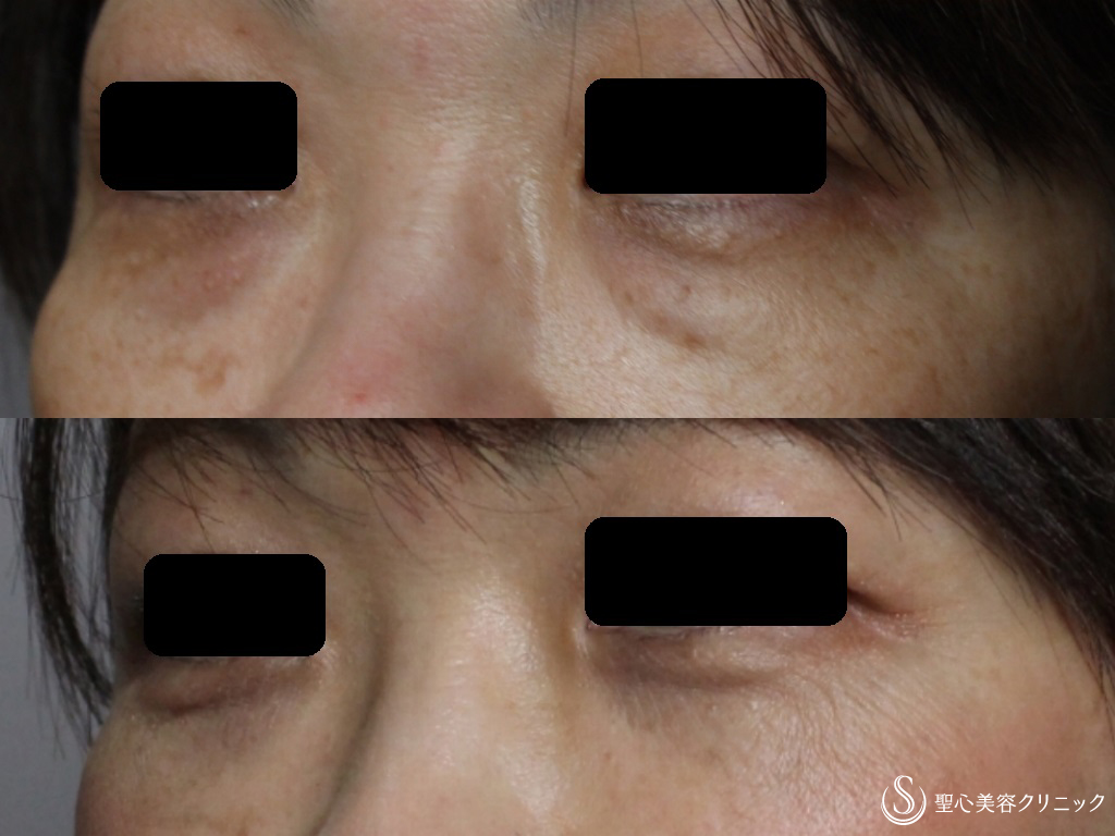 【50代女性・皮膚を切らない目の下の若返り】経結膜下脱脂法+プレミアムPRP皮膚再生療法（1か月後） After 