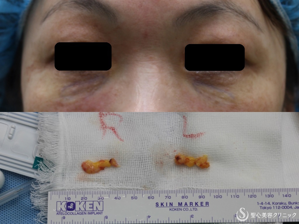 【50代女性・皮膚を切らない目の下の若返り】経結膜下脱脂法+プレミアムPRP皮膚再生療法（1か月後） Before 