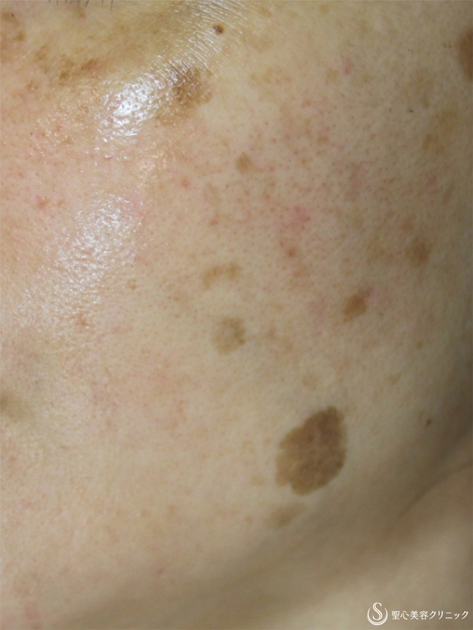 【女性・顔のシミ】レーザー+ライムライト+ヒト脂肪幹細胞上清クリーム（3年後） Before 