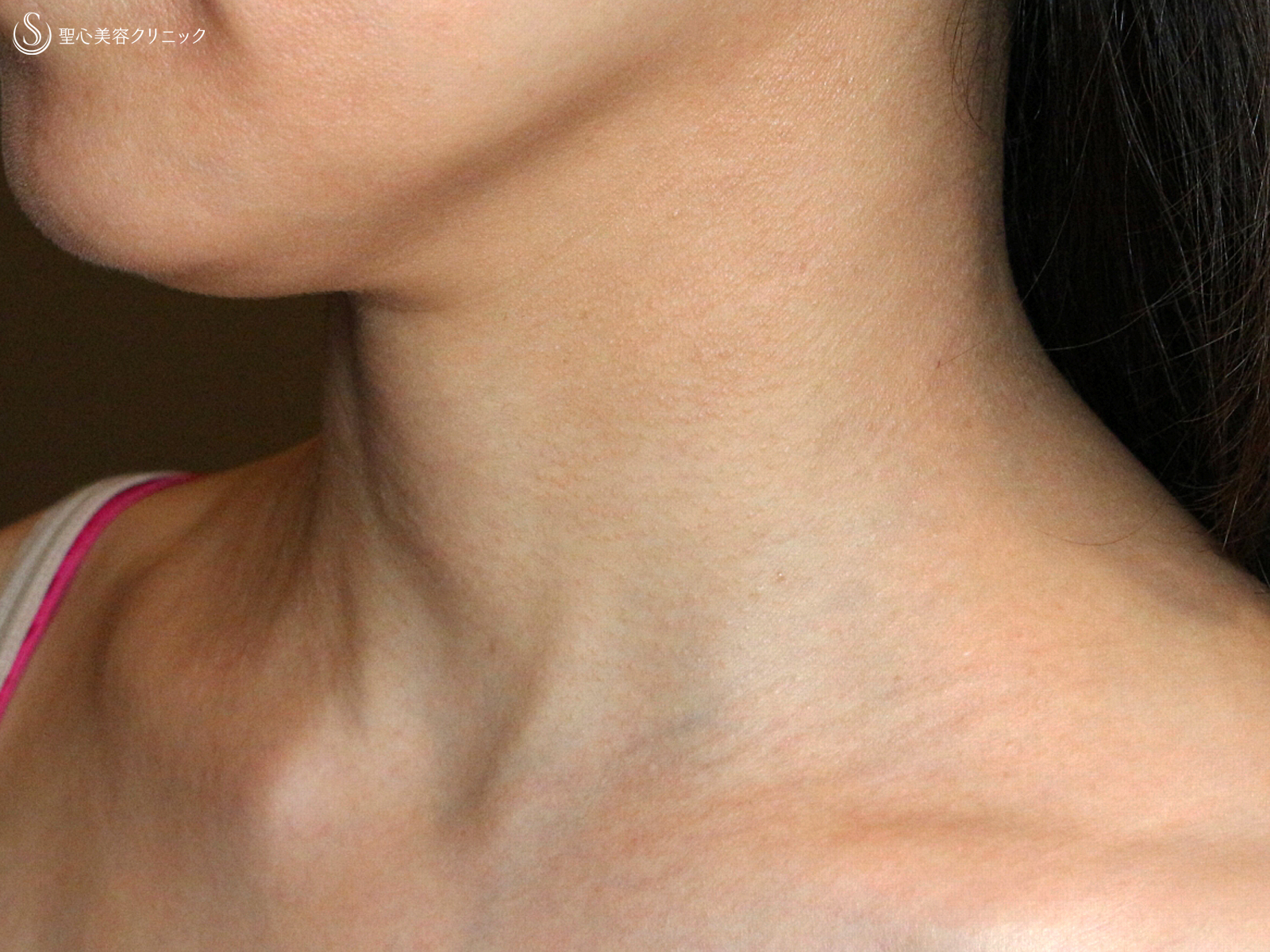 【40代女性・首の横ジワを無かったことに】プレミアムPRP皮膚再生療法（6ヶ月後） After 