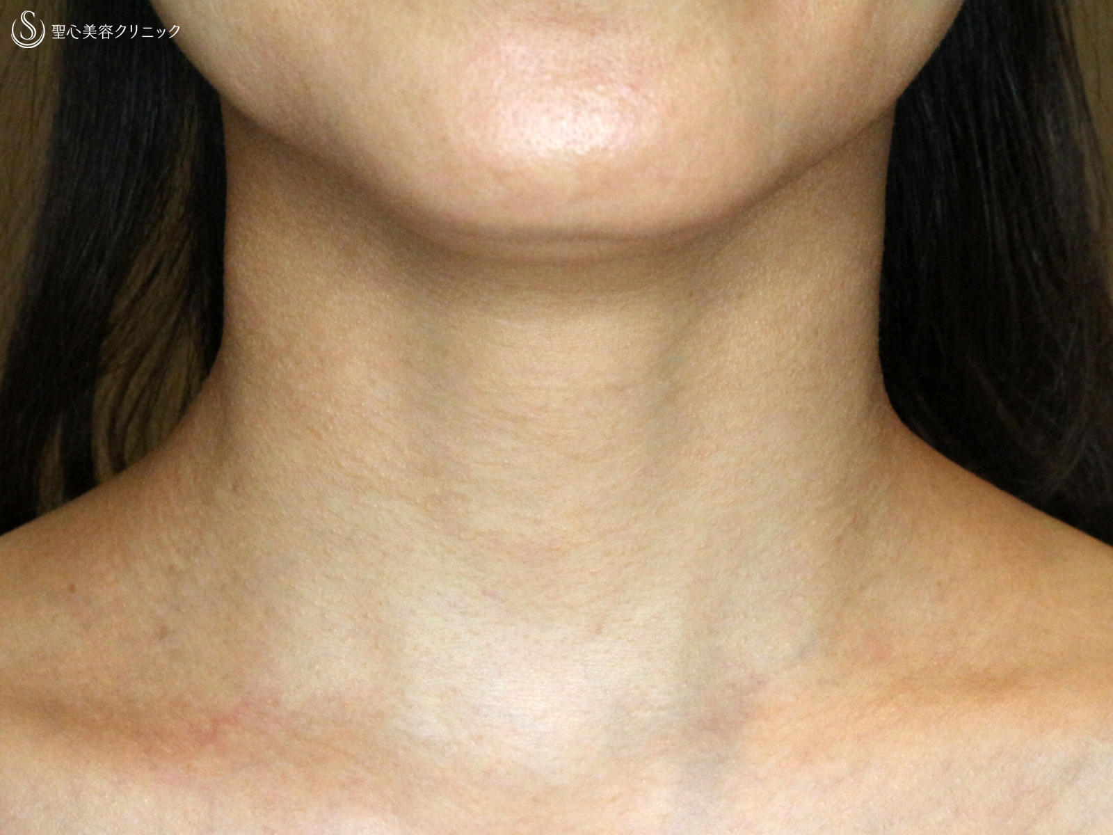 【40代女性・首の横ジワを無かったことに】プレミアムPRP皮膚再生療法（6ヶ月後） After 
