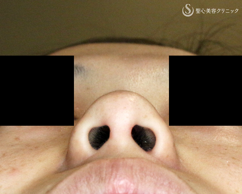 【30代女性・正面から鼻の穴が見える大きな鼻】小鼻縮小術+α法（4ヶ月後） After 