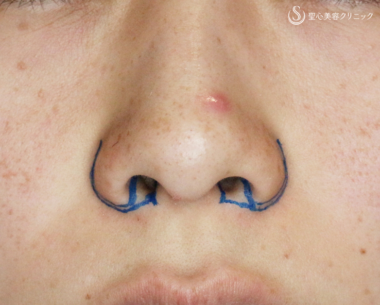 【30代女性・正面から鼻の穴が見える大きな鼻】小鼻縮小術+α法（4ヶ月後） Before 