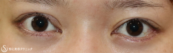 【20代女性・他院修正手術】眼瞼下垂症切開術後の修正（修正手術前と修正手術3週間後） Before 