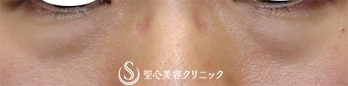 【30代女性・目の下のたるみ､凹みを改善】経結膜下脱脂術＋プレミアムPRP皮膚再生療法 (5ヶ月後) Before 