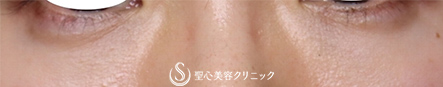【30代女性・目の下のたるみ､凹みを改善】経結膜下脱脂術＋プレミアムPRP皮膚再生療法 (5ヶ月後) After 