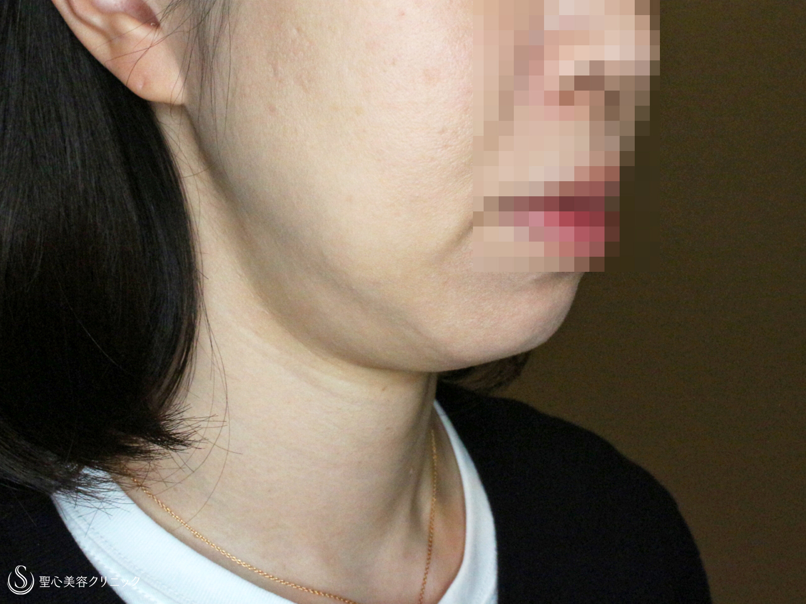 【40代女性・最新の二重アゴ＆小顔治療】ウルトラセルQ+リニア4.5mm（3回後） Before 