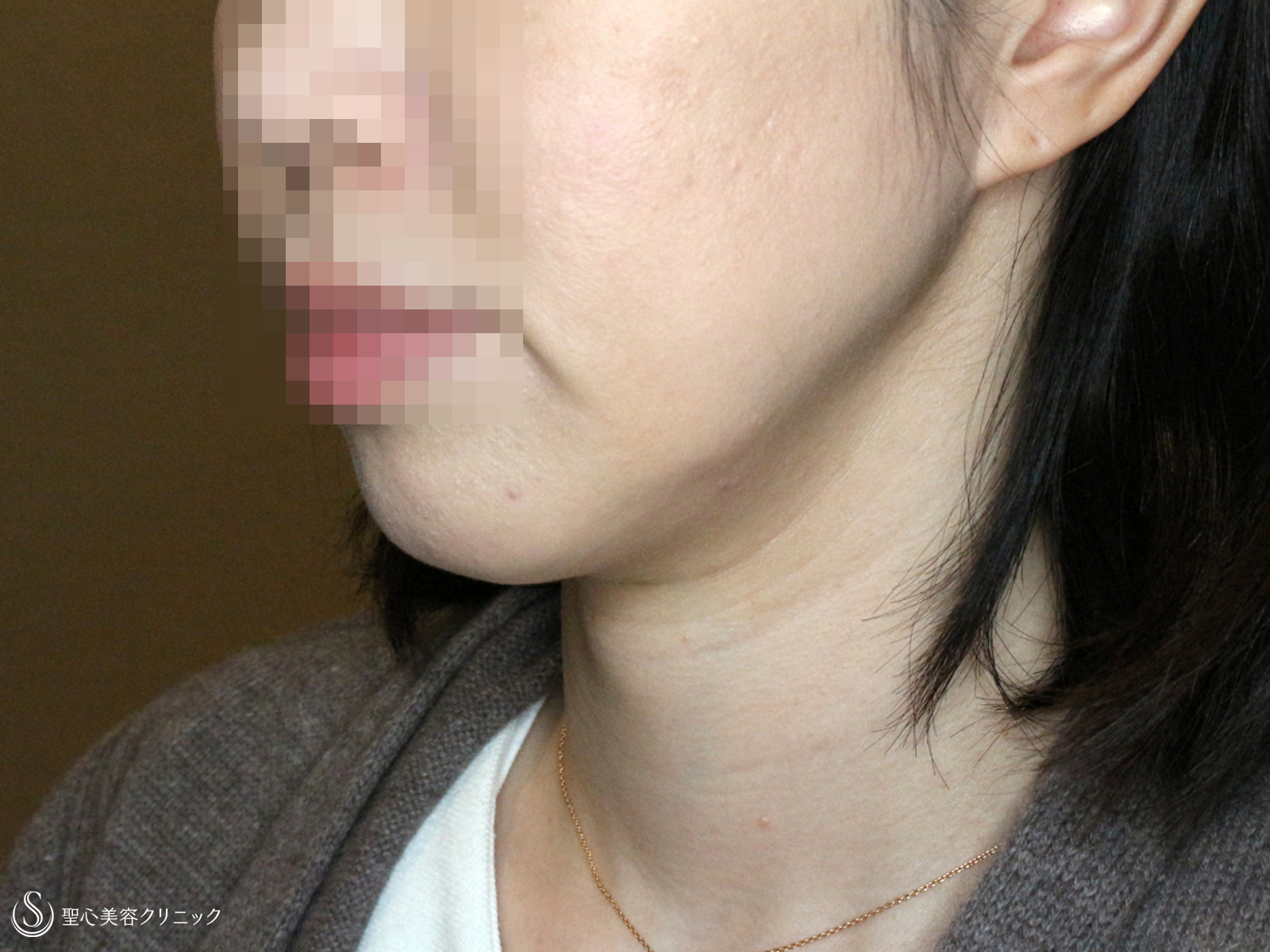 【40代女性・最新の二重アゴ＆小顔治療】ウルトラセルQ+リニア4.5mm（3回後） After 