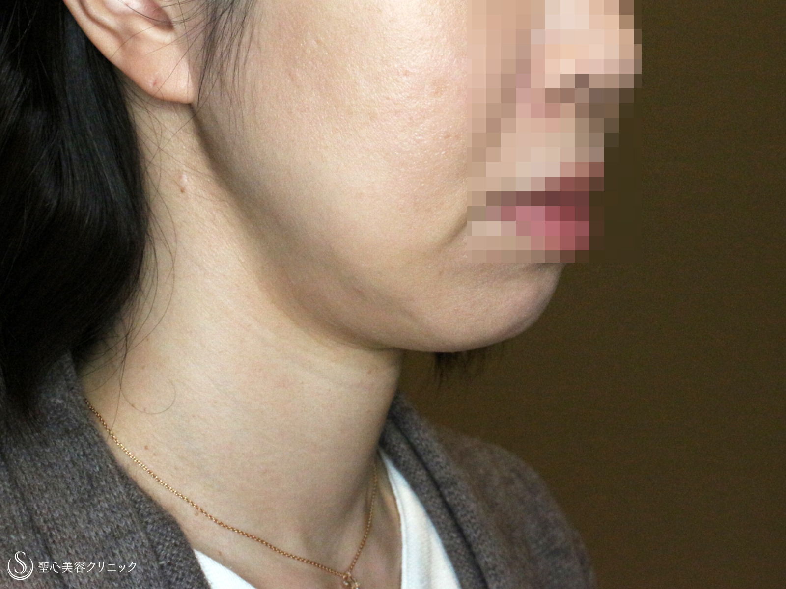 【40代女性・最新の二重アゴ＆小顔治療】ウルトラセルQ+リニア4.5mm（3回後） After 