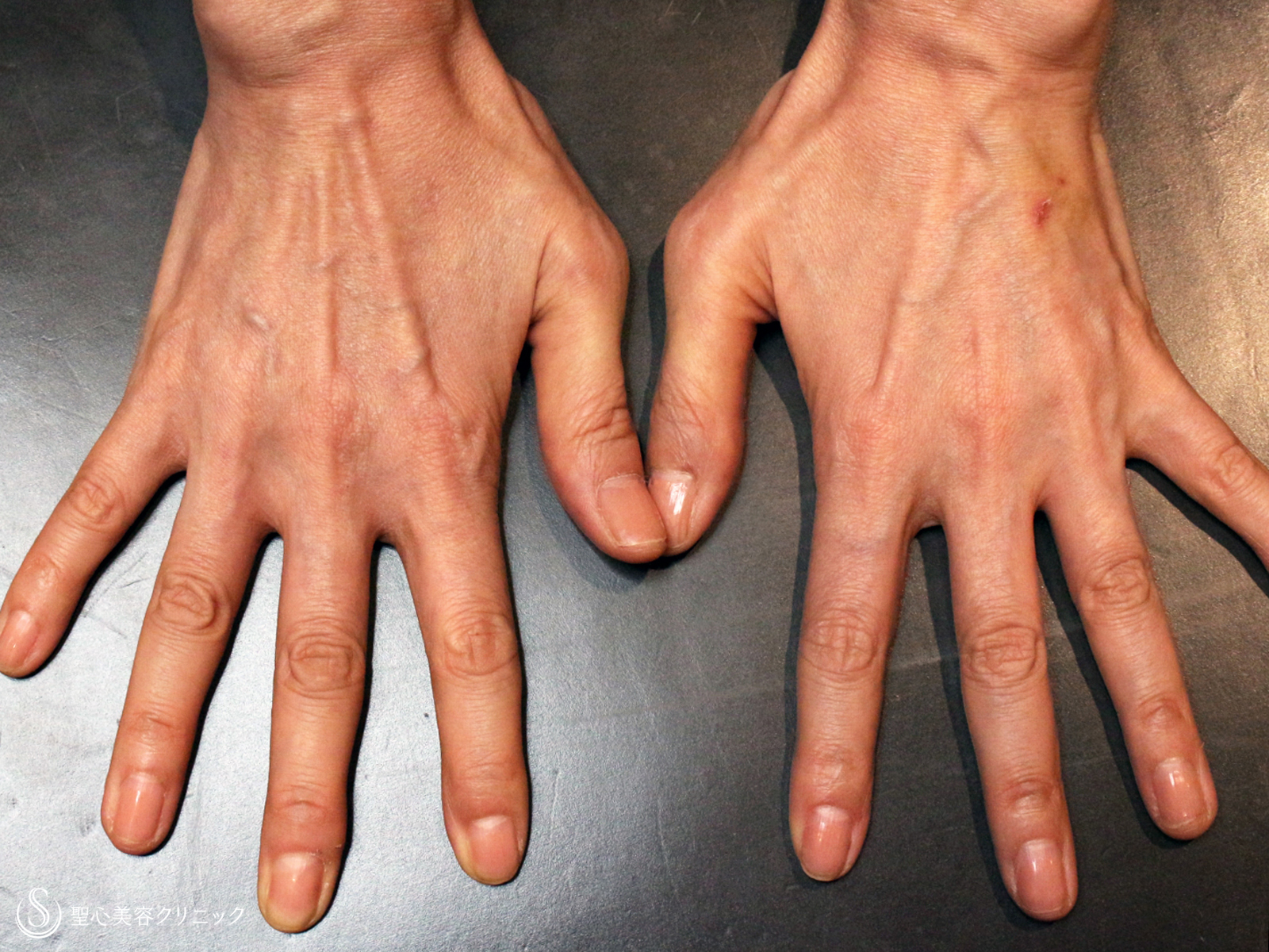 【50代女性・「手の甲」究極のアンチエイジング】プレミアムPRP皮膚再生療法（7ヶ月後） Before 