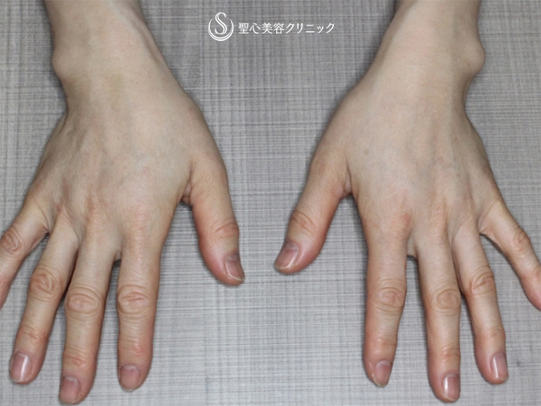 【50代女性・手の甲、手首をプレミアムPRP皮膚再生療法で更に綺麗に!!】プレミアムPRP皮膚再生療法（3本注入後） After 