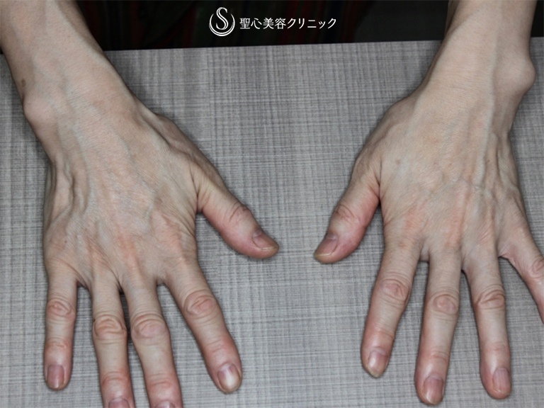 【50代女性・手の甲、手首をプレミアムPRP皮膚再生療法で更に綺麗に!!】プレミアムPRP皮膚再生療法（3本注入後） Before 