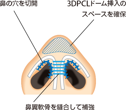 鼻先を切開