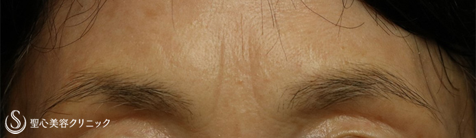 【70代女性・眉間のしわ】プレミアムPRP皮膚再生療法（5ヶ月後） Before 
