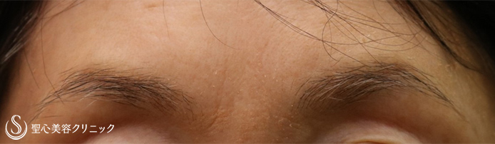 【70代女性・眉間のしわ】プレミアムPRP皮膚再生療法（5ヶ月後） After 