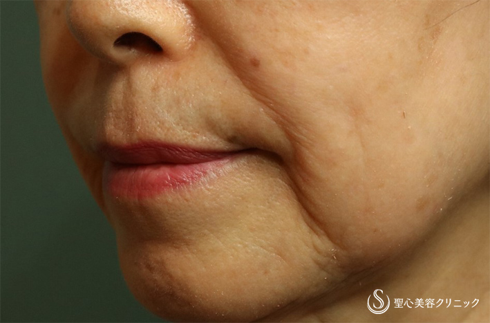 【70代女性・マリオネットラインを目立たなく】プレミアムPRP皮膚再生療法（5ヶ月後） Before 