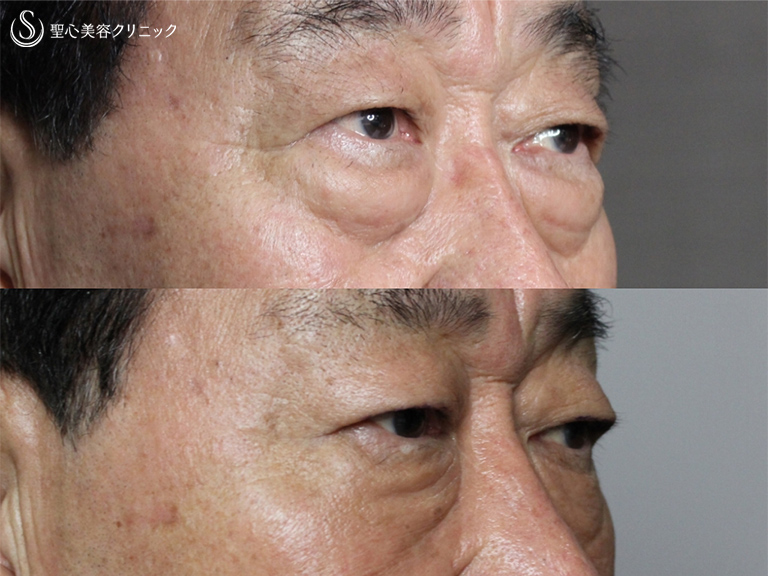 【70歳男性・皮膚を切らないで目の下の若返り】 目の下の脂肪取り+プレミアムPRP皮膚再生療法（3ヶ月後） After 