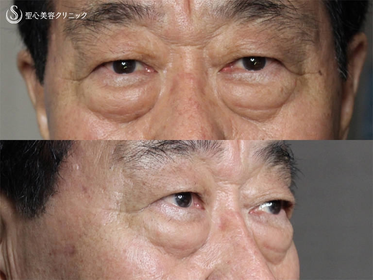 【70歳男性・皮膚を切らないで目の下の若返り】 目の下の脂肪取り+プレミアムPRP皮膚再生療法（3ヶ月後） Before 