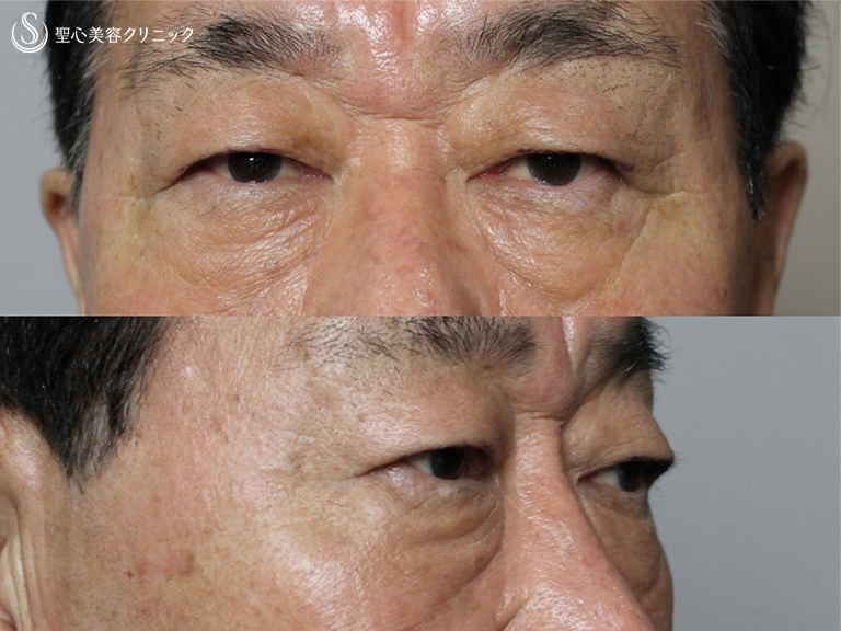 70歳男性 皮膚を切らないで目の下の若返り 目の下の脂肪取り プレミアムprp皮膚再生療法 3ヶ月後 症例写真 美容整形 美容外科なら聖心美容クリニック
