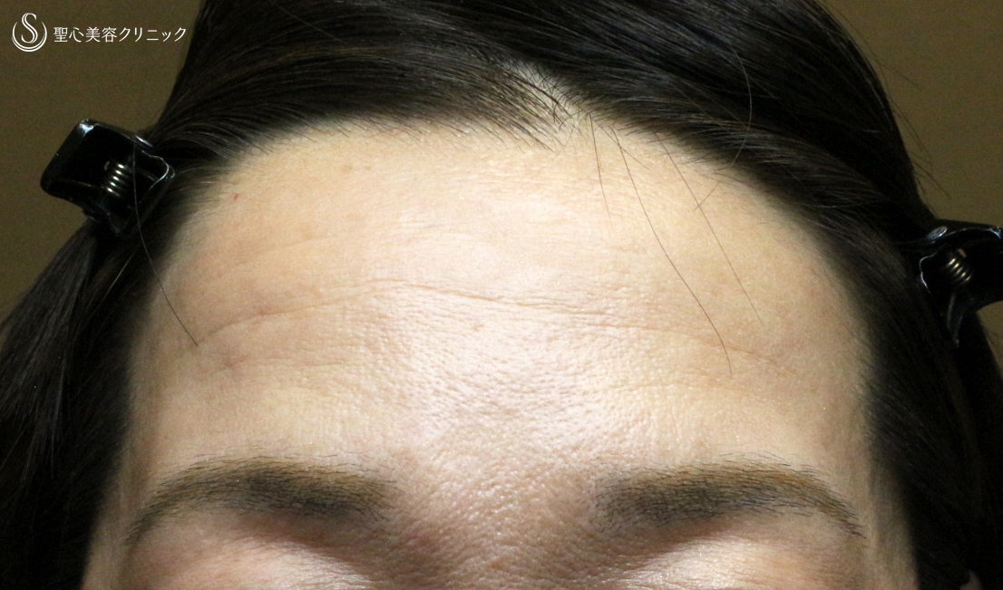 【50代女性・額＆こめかみの凹凸を丸く】プレミアムPRP皮膚再生療法（7年後） Before 