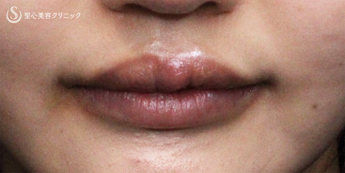【20代女性・口唇のバランスを改善】プレミアム口角挙上、下口唇ヒアルロン酸注入、上口唇ヒアルロニダーゼ注入（施術後１ヶ月） After 
