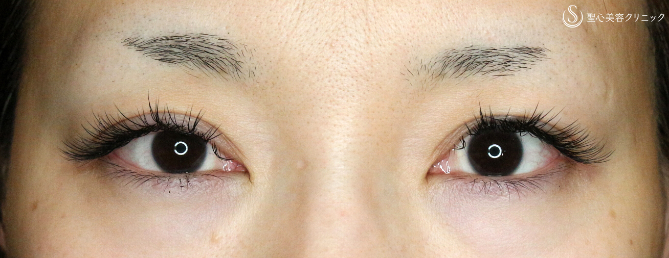 【30代女性・難しい左右差を切らずに】切らない眼瞼下垂+α法＆マイクロメソッド+α（1ヶ月後） Before 
