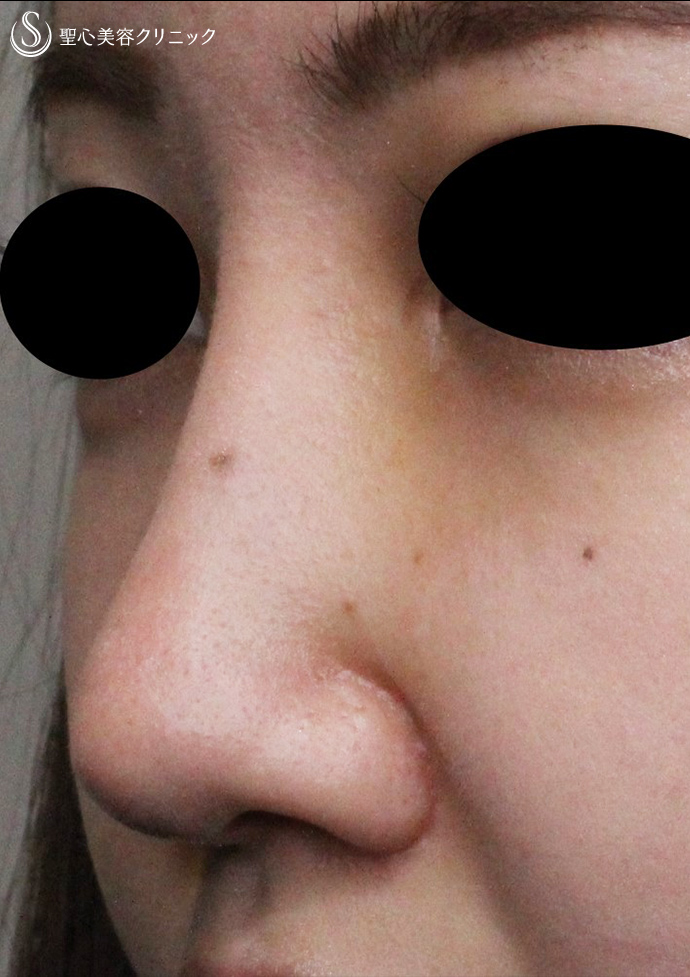 【20代女性・自然に鼻筋を通す】鼻プロテーゼ挿入＋耳介軟骨移植（鼻尖形成）（術後1ヶ月） After 