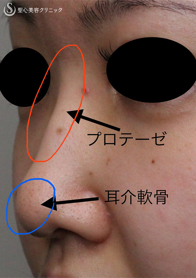 【20代女性・自然に鼻筋を通す】鼻プロテーゼ挿入＋耳介軟骨移植（鼻尖形成）（術後1ヶ月） Before 